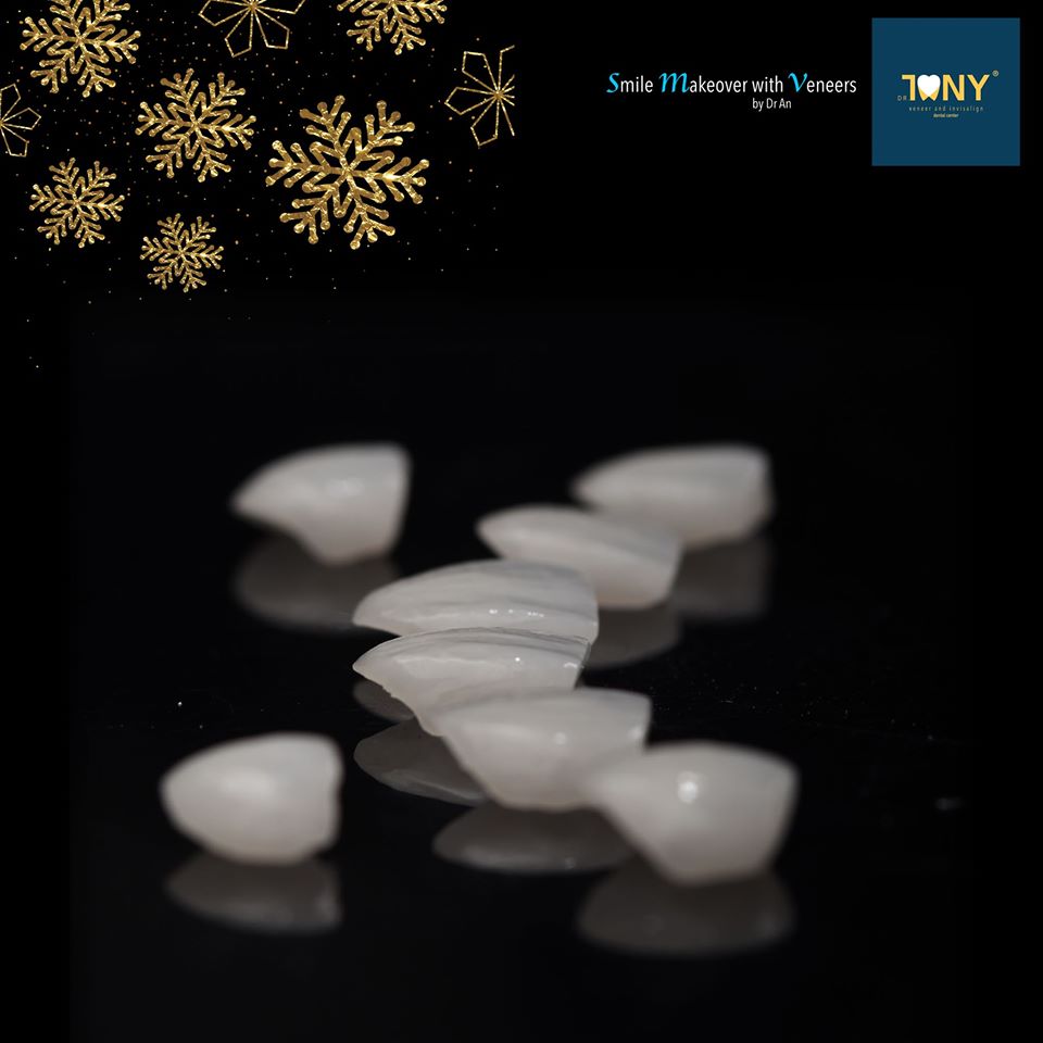 Mặt dán sứ veneer